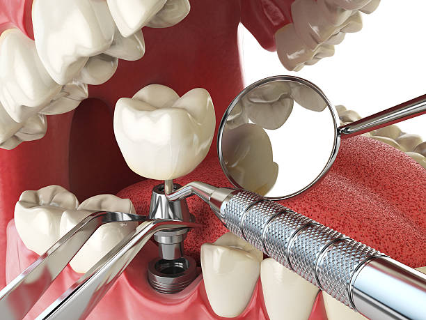 Best Emergency Dental Care for Abscessed Tooth in Rmichael, CA